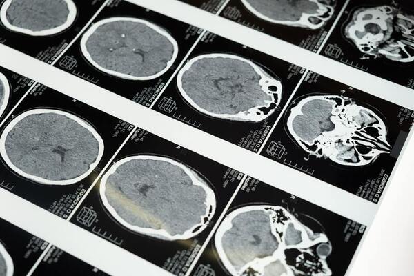 Contrasting role of <i>ASCC3</i> and <i>ALKBH3</i> in determining genomic alterations in Glioblastoma Multiforme