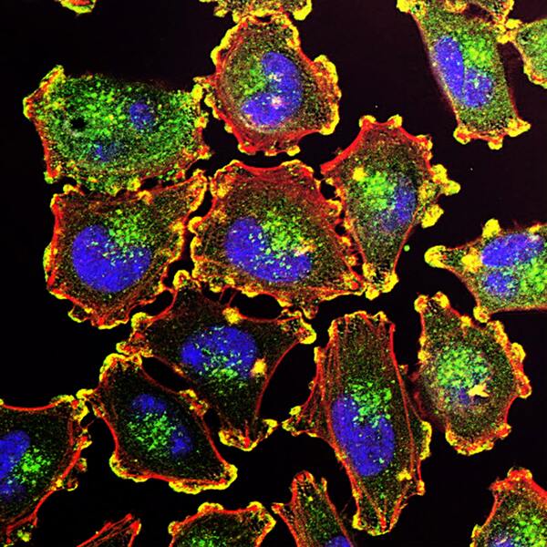 siRNA-dependent KCNMB2 silencing inhibits lung cancer cell proliferation and promotes cell death