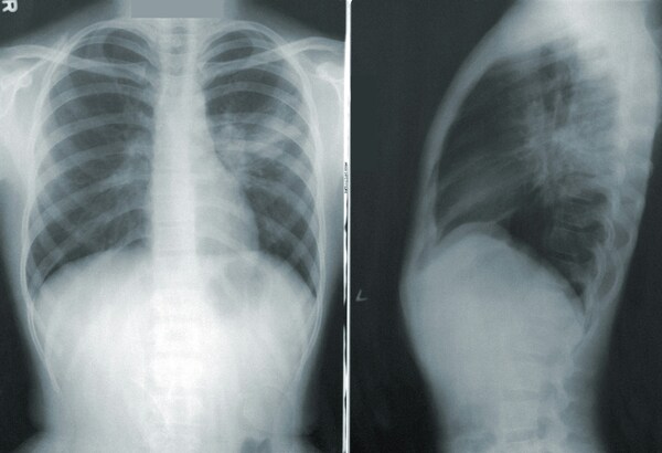 Lung region complexity affects Grad-CAM and Deep Taylor outcomes in pneumonia predictions